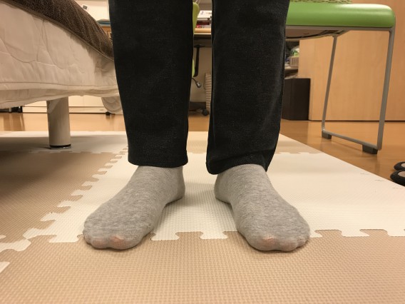 足の甲の痛み（左甲高いハイアーチ）